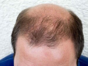 ریزش مو آندروژنیک (Androgenetic alopecia)