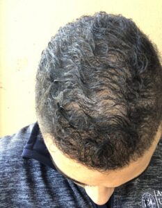 ریزش مو تلوژن افلوویوم (Telogen effluvium)