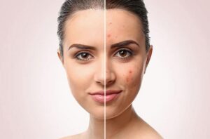 راه های از بین بردن جوش برای همیشه
