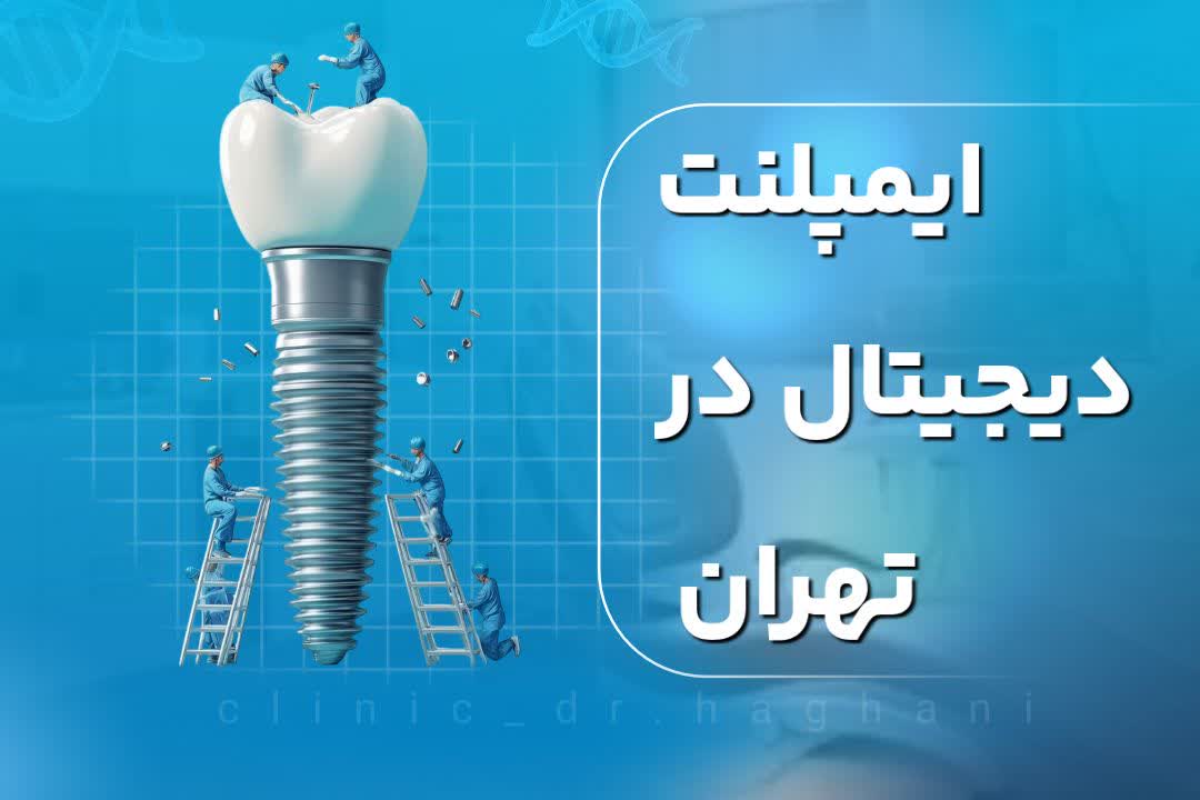 ایمپلنت دیجیتال در تهران